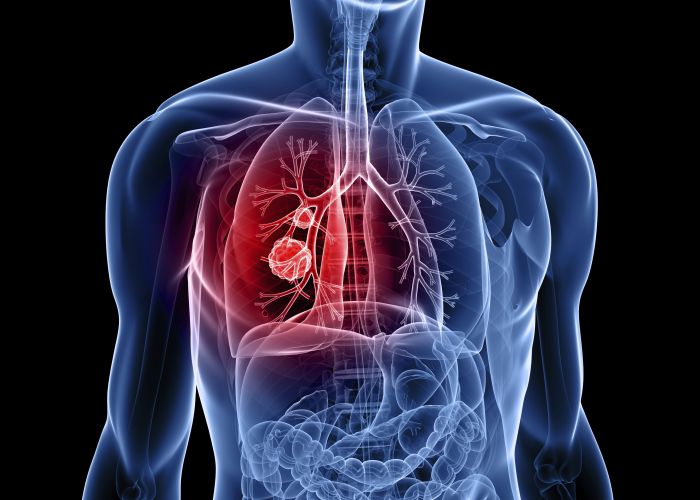 Karcinom pluća – podmukla bolest