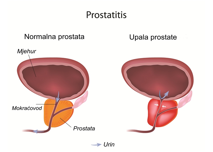 Upala prostate – Prostatitis